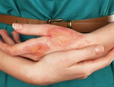 Έτσι αντιμετωπίζεται σωστά ένα έγκαυμα